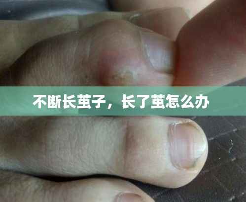 不断长茧子,长了茧怎么办